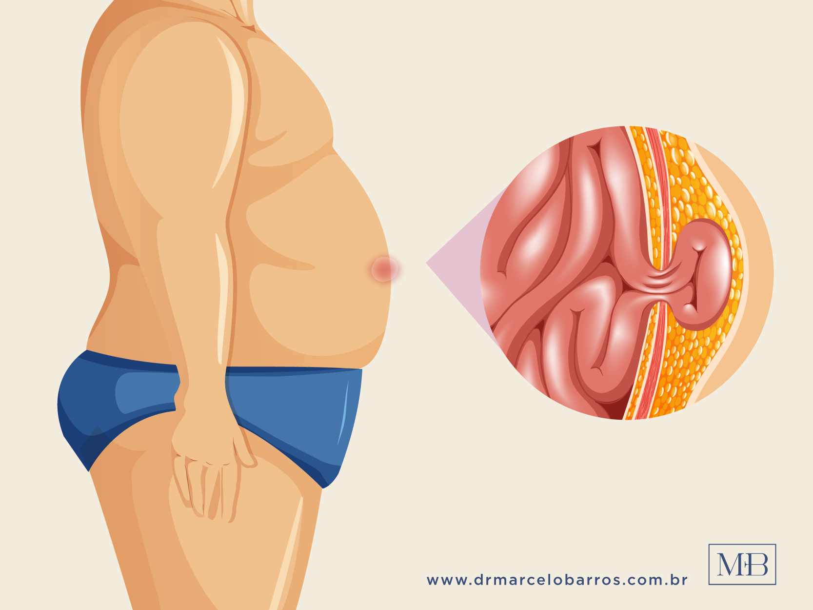 Dor abdominal após o exercício físico? Pode ser hérnia – Dr